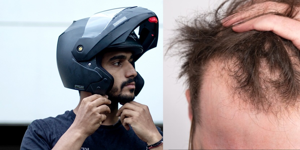 does helmet cause hair loss